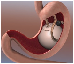 Intragastric balloon