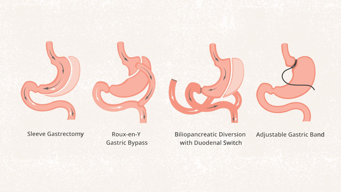 When is Bariatric Surgery the Best Option for Weight Loss? Health