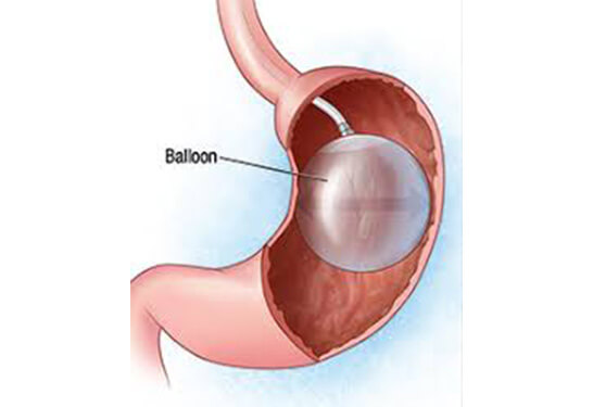 Kers massa Lee Intragastric balloon | Gastric Balloon | Weight Loss Surgery In Pune