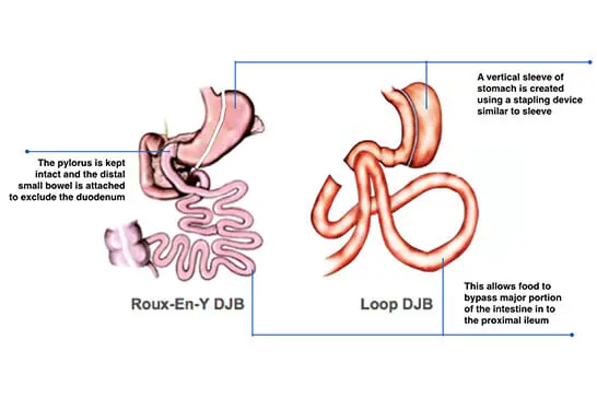 Sleeve Gastrectomy with Duodeno-Jejunostomy(DJB)