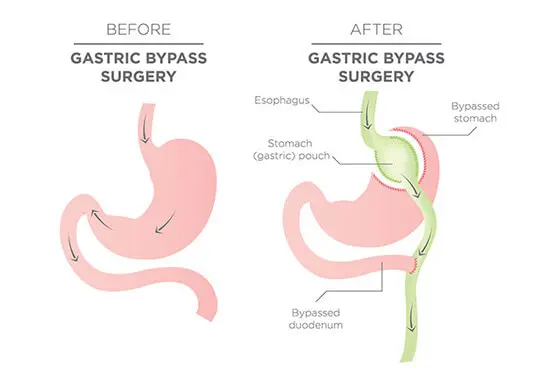 Roux-en Y Gastric Bypass Surgery