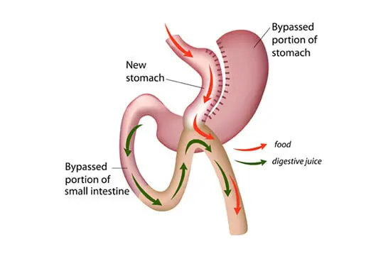 Mini Gastric Bypass / Single anastomosis Gastric By-pass