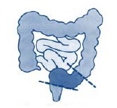 Sigmoid Colectomy