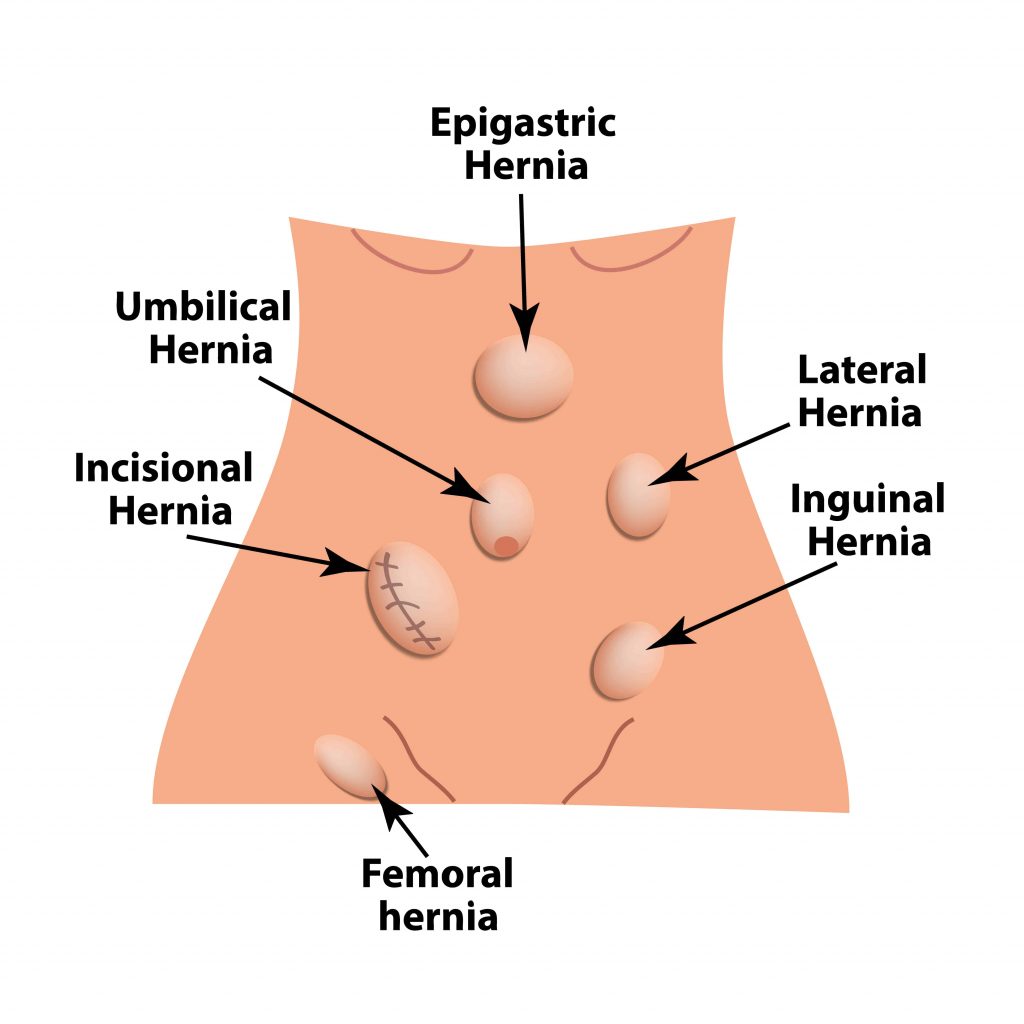 Types of hernia, Inguinal hernia treatment in Pune, Inguinal hernia treatment in Pune, Femoral hernia treatment in Pune,Incisional hernia treatment in Pune, Umbilical hernia treatment in Pune, Lateral hernia treatment in Pune, Epigastric hernia treatment in Pune, Inguinal Hernia, Umbilical hernia