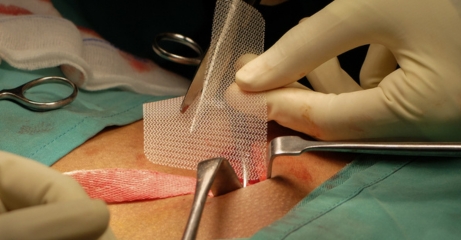 Use of Mesh
